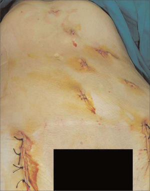 Heridas quirúrgicas correspondientes a las miniincisiones de los trocares laparoscópicos y cicatrices inguinales.