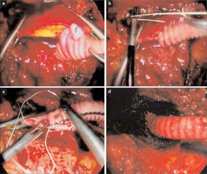 a) Inicio de la anastomosis aortoprotésica, con anudado intracorpóreo; b) Hemisutura posterior (CV3), tensándose la sutura; c) Hemisutura anterior, iniciada en el talón para anudarse en el vértice con la hemisutura posterior. d) Injerto aortomonofemoral desclampado.