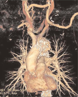 Angio-TAC de revascularización de los troncos supraaórticos.