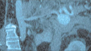 Tomografía computarizada abdominal con contraste intravenoso que muestra un aneurisma de arteria esplénica roto y líquido perilesional.