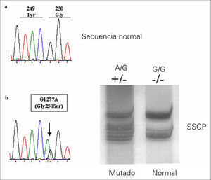 Detección de la mutación G1277A del gen del inhibidor dependiente de la proteína Z mediante análisis por polimorfismo conformacional de banda simple (SSCP): a) Alelo normal; b) Alelo mutado.