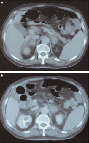 Tomografía axial computarizada abdominal, que pone de manifiesto la suprarrenal derecha (a) y la izquierda (b), aumentadas de tamaño por hemorragia suprarrenal.