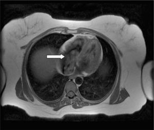 Angiorresonancia que muestra la entrada en el ventrículo derecho del tumor (flecha).