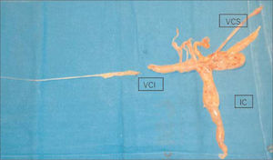 Imagen del tumor tras la resección, que muestra las diferentes porciones. IC: porción intracardíaca; VCI: vena cava inferior; VCS: vena cava superior.