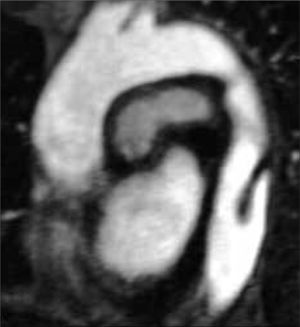 Angiorresonancia magnética de la aorta torácica descendente con trombo mural flotante.