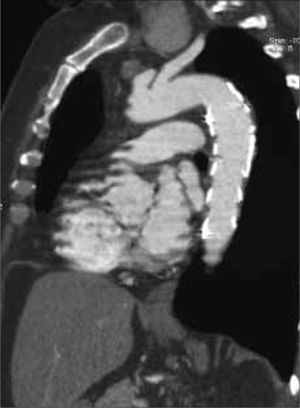 Angiotomografía computarizada de control a los seis meses que confirma la exclusión del trombo aórtico, sin evidencia de fugas.