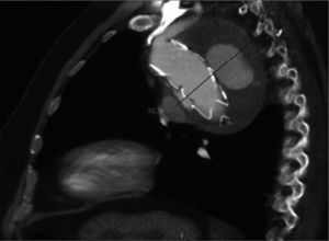 Tomografía axial computarizada con contraste intravenoso de la aorta torácica descendente, que muestra un aneurisma de aorta torácica descendente de 88 mm de diámetro máximo y extravasación de contraste en el saco aneurismático, lo cual se corresponde con una fuga tipo I proximal y distal.