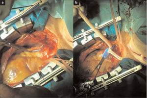Injerto desde la aorta ascendente al tronco braquiocefálico y la carótida común izquierda, con prótesis bifurcada de dacron de 14–7 mm: a) Abordaje mediante esternotomía media y clampaje lateral del arco aórtico; b) Anastomosis proximal sobre el arco aórtico. Injerto bifurcado con rama para el tronco braquiocefálico y rama tunelizada para la carótida izquierda.