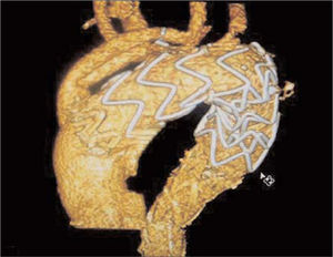 Reconstrucción de tomografía computarizada con contraste intravenoso del arco aórtico y aorta torácica descendente, que muestra la permeabilidad del injerto desde la aorta ascendente al tronco braquiocefálico y la carótida común izquierda, y la correcta colocación de la endoprótesis torácica.