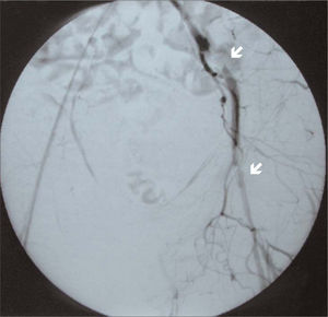 Arteriografía intraoperatoria. Áreas de hiperplasia intimal en las anastomosis (flechas).