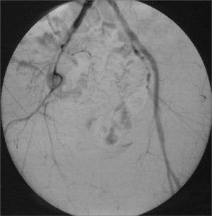 Arteriografía intraoperatoria final. Bypass iliofemoral recanalizado (obsérvese la arteria hipogástrica permeable).