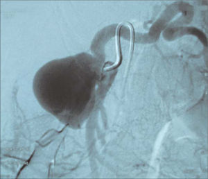 Arteriografía donde se muestra el aneurisma de arteria esplénica con origen en la raíz de la arteria mesentérica superior.