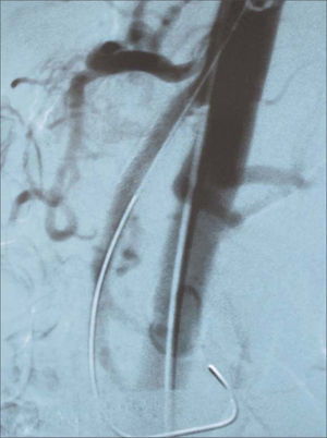 Colocación de stent recubierto en origen de arteria mesentérica superior con exclusión y trombosis de aneurisma esplénico aberrante.