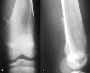Caso 1: a) Radiografía simple AP de la rodilla izquierda. Se distinguen dos OC; b) En una proyección 'L se observa el crecimiento hacia el paquete vascular. Se aprecia el aumento de partes blandas como consecuencia de la hemorragia arterial.