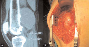 Caso 3: a) Tomografía axial computarizada sin contraste, urgente, donde se aprecian las dimensiones del pseudoaneurisma y la fractura del OC; b) Imagen intraoperatoria de la cúspide del pseudoaneurisma.