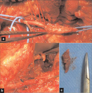 Caso 3: a) Imagen intraoperatoria de la dilaceración arterial poplítea y debilitación de la pared circundante; b) Arteria reconstruida con parche venoso y OC afilado, señalado por la pinza; c) Imagen del OC junto a un mosquito quirúrgico.