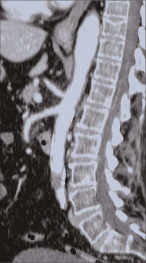Tomografía computarizada abdominal: trombosis segmentaria corta de la aorta infrarrenal, a la altura de L3, donde se sitúa una placa posterior calcificada. La aorta terminal y su bifurcación se encuentran permeables.