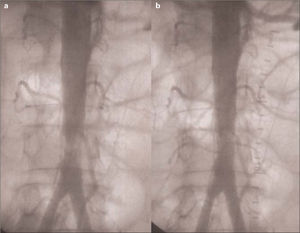 Arteriografía intraoperatoria: a) previa a ATP: estenosis corta, calcificada y grave de la aorta terminal; b) Resultado tras ATP: leve estenosis residual, luz aórtica de 10 mm, se visualizan varias arterias lumbares.