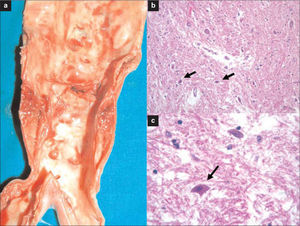 Hallazgos de la autopsia: a) Placa parcialmente calcificada y fisurada en la aorta infrarrenal distal; b) Infarto no hemorrágico de la médula espinal lumbar, que muestra neuronas rojas en las astas anteriores (tinción de hematoxilina-eosina); c) Detalle de neurona roja (tinción de hematoxilina-eosina).