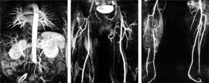 Angiorresonancia magnética: oclusión de ilíaca común bilateral, trombosis de arteria femoral común derecha y oclusión de tibial anterior y tronco tibioperoneo, con recanalización en tibial posterior y peronea.