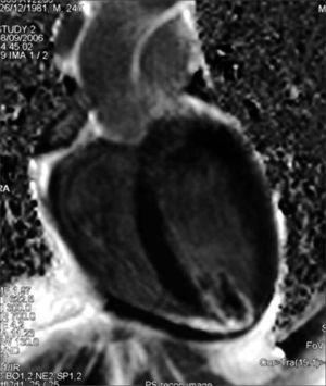 Resonancia magnética cardíaca con trombo pediculado en el ventrículo.