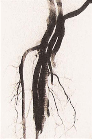 Fístula arteriovenosa dependiente de la arteria peronea.