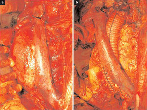 a) Imagen intraoperatoria de la vena cava izquierda; b) Imagen intraoperatoria de bypass aortobiilíaco.
