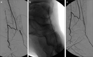 a) Obstrucción larga de la arteria tibial anterior distal; b) Angioplastia de la arteria tibial anterior con catéter-balón de 2×120mm; c) Resultado final.