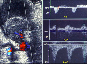 Dúplex que muestra el pseudoaneurisma carotídeo (izquierda). CP: imagen tipica de flujo en 'yin yang' en el pseudoaneurisma; ICA: flujo anterógrado en la arteria carótida interna; ECA: flujo invertido en la arteria carótida externa.