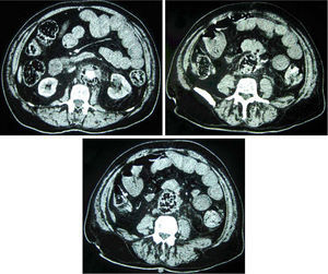 Angio-TC abdominal, que muestra gas aórtico, mayor densidad de tejidos periprotésicos y trombosis de aorta abdominal infrarrenal. El asterisco indica la fístula aortoentérica.
