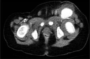 Tomografía axial computarizada que muestra el pseudoaneurisma gigante de la arteria femoral común izquierda.