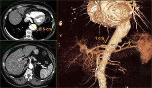 Angio-TC preoperatoria que muestra un aneurisma de aorta torácica de 5cm de diámetro máximo, con cuello distal hasta el tronco celíaco de 1cm.