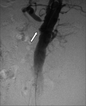 Imagen arteriográfica. Oclusión del stent de la arteria meséntérica superior (flecha) y estenosis crítica en el ostium del tronco celíaco.