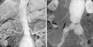 Aortoarteriografia previa a cirugia de resección del alleurisma de aorta abdominal e implantación de bypass aortobifemoral; se objetiva Un aneurisrma aórtico e ilíaco.
