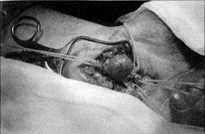 Aneurisma de 2,5cm, control proximal y distal del saco aneurismático.