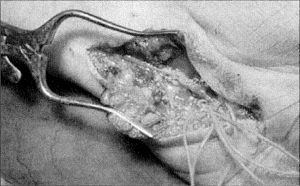 Tras exéresis del saco aneurismático,anastomosis terminoterminal microquirúrgica.