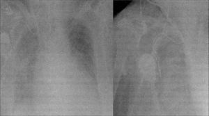 Radiografías en las que se objetiva el atrapamiento existente entre el catéter de Swan-Ganz y el electrodo del marcapasos.