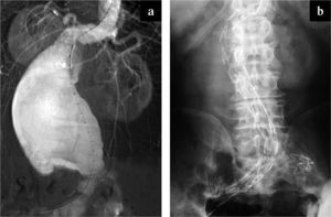 Aneurisma de aorta abdominal gigante con cuello complejo asociado a un riñón en herradura. a) Arteriografía. b) Control radiológico posquirúrgico (aortomonoilíaco, oclusor e injerto cruzado).
