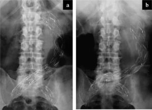 Caso 1, fallecimiento. Radiografía de abdomen: a) en el postoperatorio inmediato; b) el día del fallecimiento, con migración de la endoprótesis y caída al saco aneurismático.