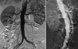 Arteriografía: permeabilidad de troncos viscerales.