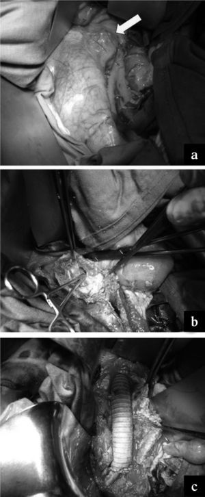a) Aneurisma aórtico sacular infrarrenal, que protruye desde la pared lateral izquierda de la aorta (flecha). b) Perforación de la pared aórtica que comunica con la cavidad del seudoaneurisma subadventicial (está introducida una pinza mosquito a través del orificio). c) Injerto aortoaórtico con prótesis de plata de 16mm y reimplantación de arteria polar renal derecha