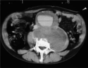 Angiotomografía computarizada: aneurisma de aorta abdominal gigante, con forma de trébol, con el hematoma hacia el músculo psoas izquierdo y destrucción de los cuerpos vertebrales.