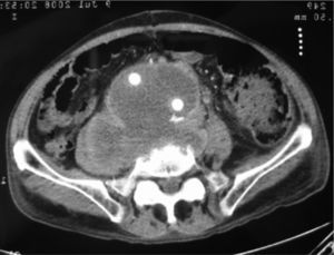 Angiotomografía computarizada: imagen posquirúrgica, una vez reparado el AAA con una prótesis bifurcada.