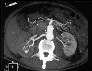 Angiotomografía computarizada: se visualiza la fístula arteriovenosa intrarrenal derecha.