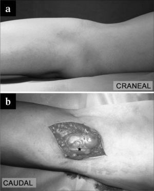 a) Visión lateral de la tumoración poplítea. b) Incisión en jarretera. Se observa el nervio ciático poplíteo externo (*).