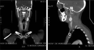 Angio-tomografía computarizada de troncos supra-aórticos.