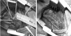 Aspecto intraoperatorio del aneurisma con resección e interposición de injerto venoso a la derecha.