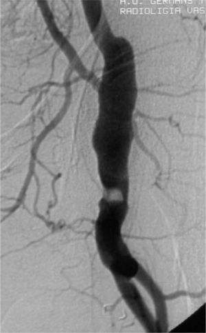 Caso 2, arteriografía que muestra bypass aneurismático y trombo en su interior.