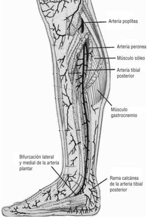 Arteria tibial posterior. Emite perforantes que surgen entre la musculatura flexora y el músculo sóleo. Imagen cedida por Attinger CE et al6.