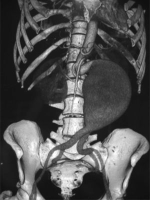 Reconstrucción del aneurisma de aorta abdominal mediante tomografía computarizada, en la que se aprecia la elongación y la excesiva angulación del cuello aneurismático.